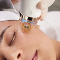 RF Microneedling